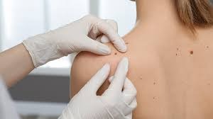 Mole Removal Side Effects: What You Should Know